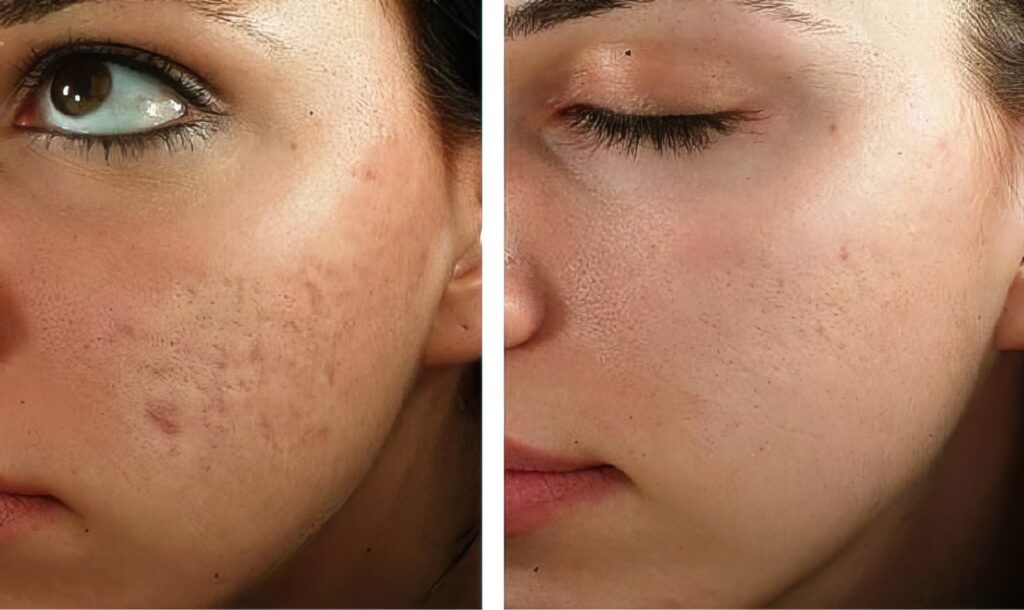 microneedling low res scale 4 00x gigapixel