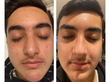 Acne Facial Treatment