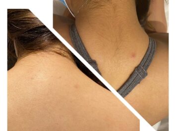 Thin hair removal treatment after only first session