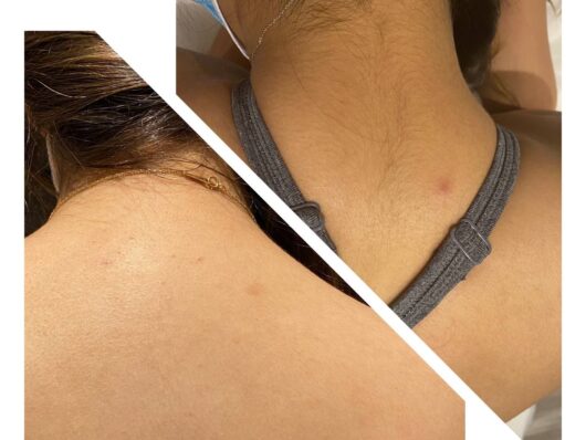 Thin hair removal treatment after only first session